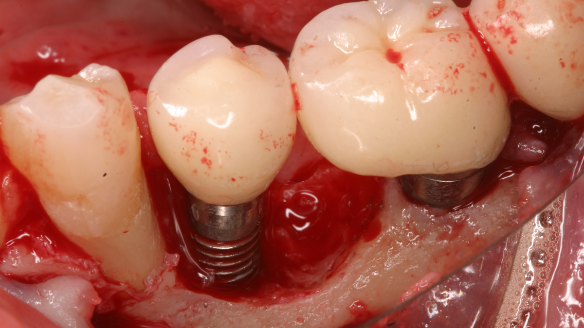 Dental implant contamination: 3 reasons behind a late-stage failure