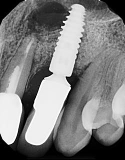 Figure 1: Radiograph of an infected implant coming from an adjacent tooth with a failed root canal. Both tooth and implant needed to be removed. Figure 1: Radiograph of an infected implant coming from an adjacent tooth with a failed root canal. Both tooth and implant needed to be removed.