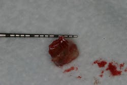 Figure 2: Cement removed from an implant that shows embedded bacteria