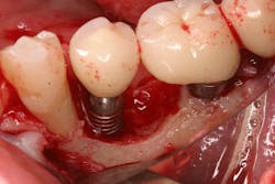 Figure 3: Bone loss around an implant that had an infection from the cement shown in Figure 2 Figure 3: Bone loss around an implant that had an infection from the cement shown in Figure 2