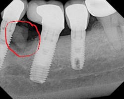 Figure 4: Radiograph of the implant shown in Figure 3 with evidence of subgingival cement Figure 4: Radiograph of the implant shown in Figure 3 with evidence of subgingival cement