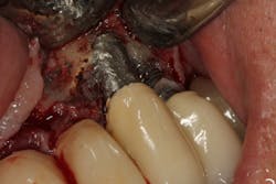 Figure 5: An implant that was treated with implantoplasty during peri-implantitis treatment, which resulted in titanium particles being embedded in the soft tissue Figure 5: An implant that was treated with implantoplasty during peri-implantitis treatment, which resulted in titanium particles being embedded in the soft tissue