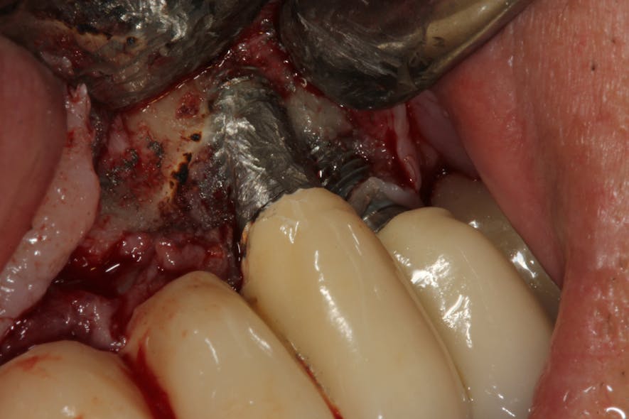 Figure 5: An implant that was treated with implantoplasty during peri-implantitis treatment, which resulted in titanium particles being embedded in the soft tissue