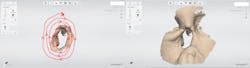 Figure 1: The TRIOS scan of a maxillofacial defect is started on the defect border in an area with great surface detail (as seen at left encircled in red) and built by scanning in the outward circular pattern drawn in red to yield an accurately stitched finalized scan (at right). Figure 1: The TRIOS scan of a maxillofacial defect is started on the defect border in an area with great surface detail (as seen at left encircled in red) and built by scanning in the outward circular pattern drawn in red to yield an accurately stitched finalized scan (at right).