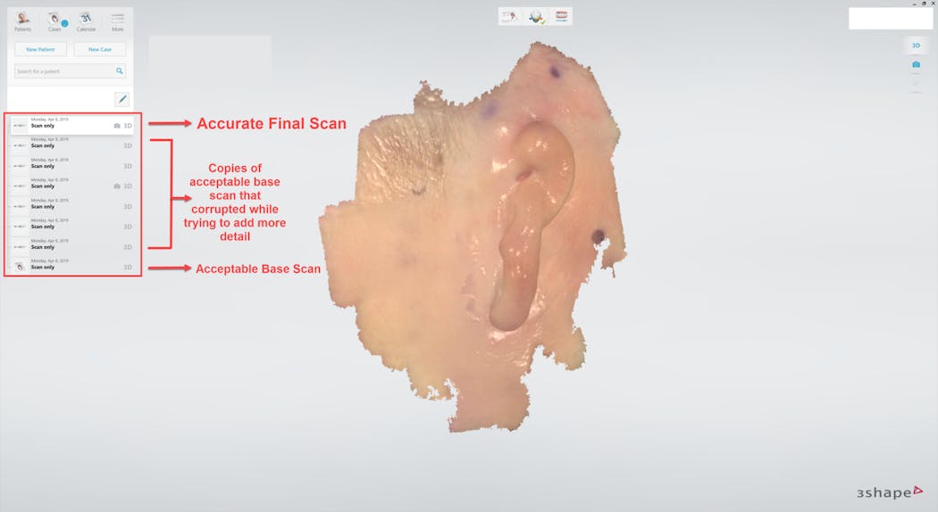 Figure 2: To avoid corrupting a scan when attempting to capture more detail, copy the acceptable base scan and complete the scanning on the copy. For this patient, due to the smooth nature of the bordering tissues of the defect, it took seven attempts to build an accurate final impression where the tissues are properly stitched into place.
