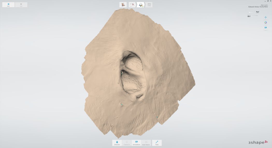 Figure 4: Off-label TRIOS scan used in the fabrication of auricular maxillofacial prosthetics.