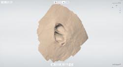 Figure 4: Off-label TRIOS scan used in the fabrication of auricular maxillofacial prosthetics. Figure 4: Off-label TRIOS scan used in the fabrication of auricular maxillofacial prosthetics.