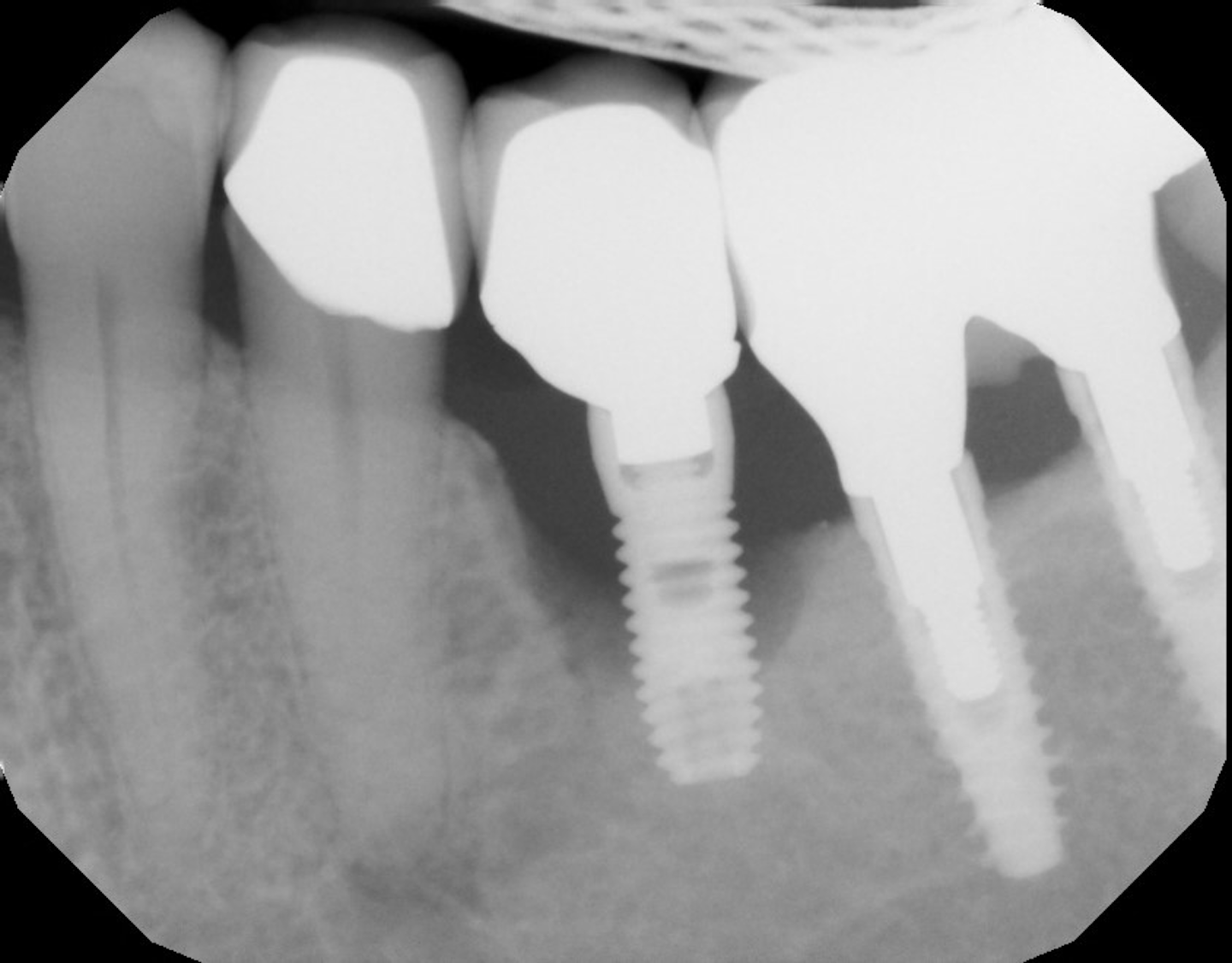 Dental Implant Failure 3 Common Medical Conditions That May Affect Success Rates Perio Implant Advisory