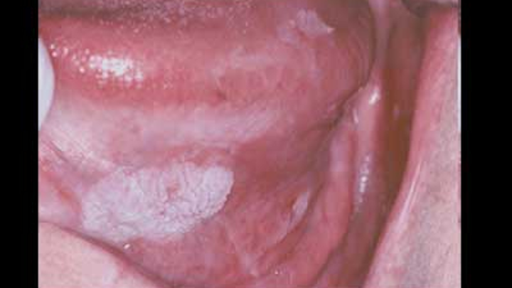 hpv virus and mouth cancer)