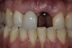 Figure 1: Example of a Ti-base debonding Figure 1: Example of a Ti-base debonding