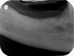 Figure 1: A preoperative radiograph shows severe vertical deficiency on the edentulous ridge.