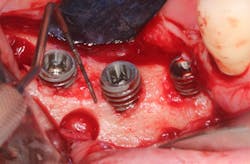Figure 2: Note the 3–5 mm high exposure of the implant surface after placement of the implants. Figure 2: Note the 3–5 mm high exposure of the implant surface after placement of the implants.