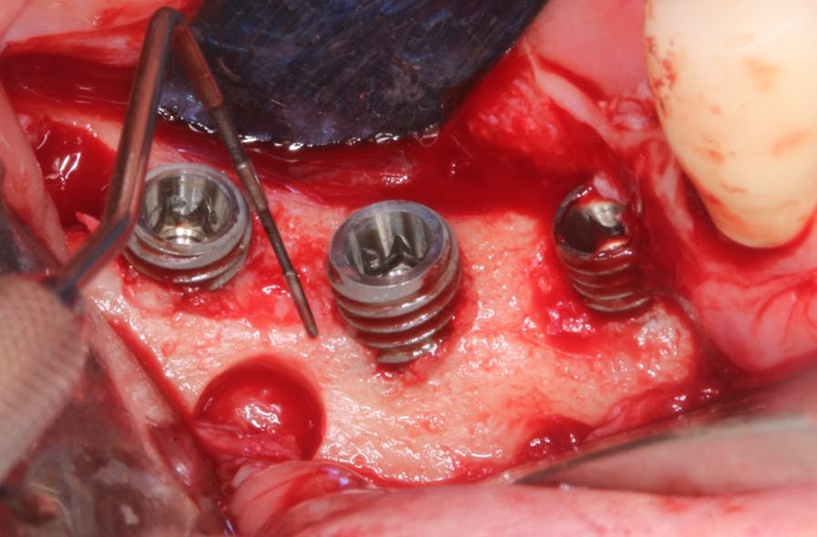 Figure 2: Note the 3&ndash;5 mm high exposure of the implant surface after placement of the implants.