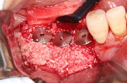 Figure 3: Sticky porcine bone graft is positioned after placing tenting abutments on the platform of all the implants. Figure 3: Sticky porcine bone graft is positioned after placing tenting abutments on the platform of all the implants.