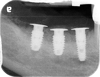 Figure 4: A postoperative radiograph shows bone grafting over the implant platform and the bony defect.