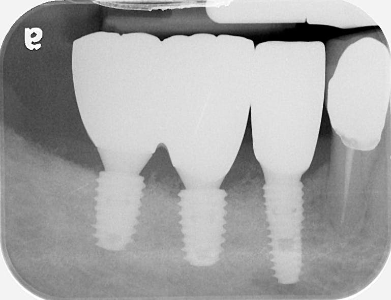 Figure 5: A radiograph of the final restoration.