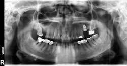 Figure 3: Implant placed in posterior maxilla of a patient with vitamin D deficiency Figure 3: Implant placed in posterior maxilla of a patient with vitamin D deficiency