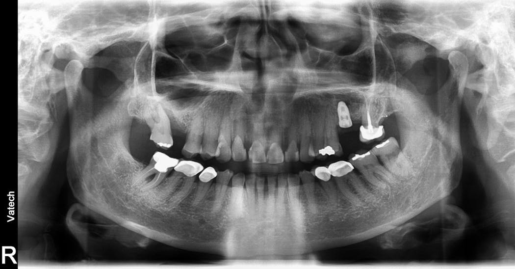 Figure 3: Implant placed in posterior maxilla of a patient with vitamin D deficiency