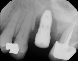 Figure 4: Early dental implant failure four months later Figure 4: Early dental implant failure four months later
