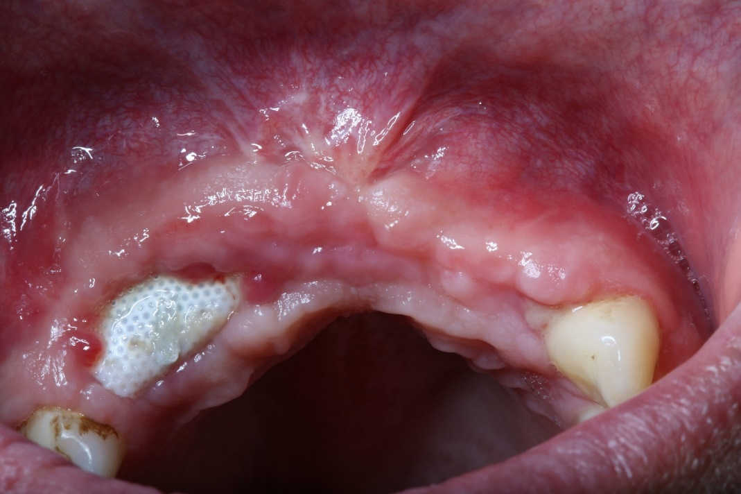 Bone augmentation: Failures and complications | Perio-Implant Advisory Bone augmentation: Failures and complications | Perio-Implant Advisory