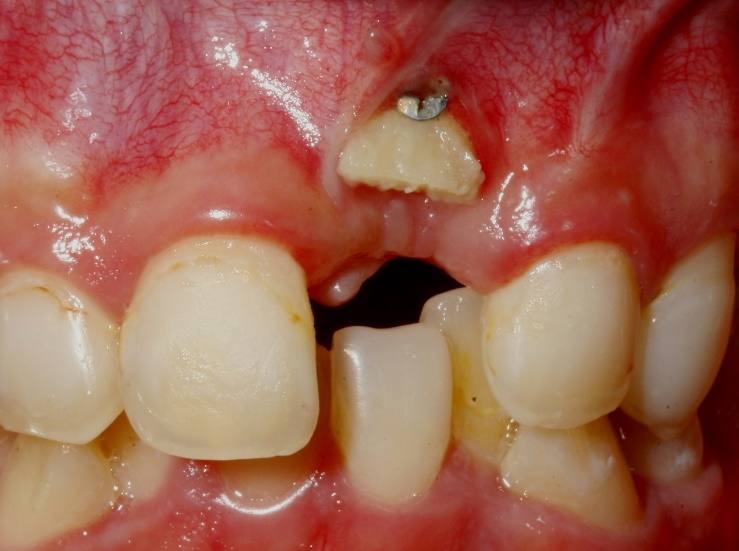 Bone augmentation: Failures and complications | Perio-Implant Advisory Bone augmentation: Failures and complications | Perio-Implant Advisory