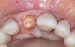 Figure 1: Socket-shield technique step by step Figure 1: Socket-shield technique step by step