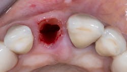 Figure 2: Socket-shield technique step by step Figure 2: Socket-shield technique step by step