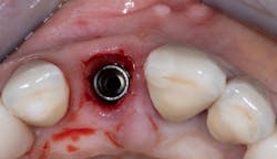 Figure 3: Socket-shield technique step by step Figure 3: Socket-shield technique step by step