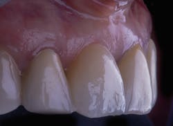 Figure 5: Final crown Figure 5: Final crown