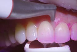 Figure 1: Using the AirFlow Prophylaxis Master to remove biofilm Figure 1: Using the AirFlow Prophylaxis Master to remove biofilm