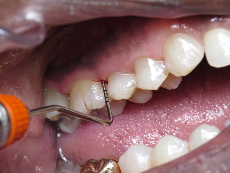 Figure 2: Checking periodontal pocket depth