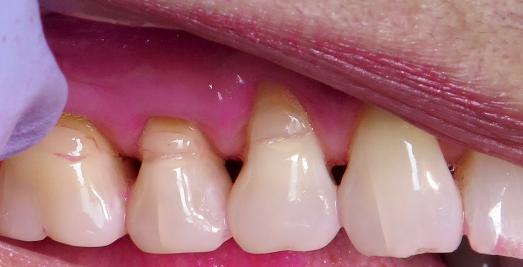 Figure 3: Saving teeth with supportive periodontal therapy and biofilm management