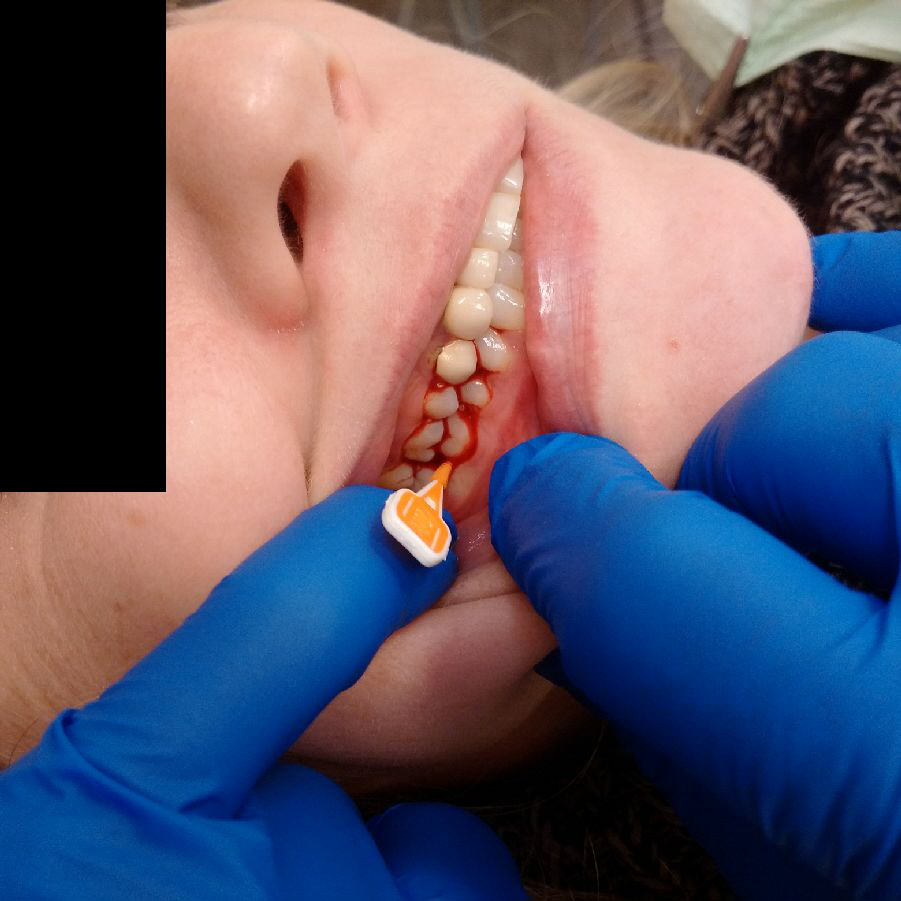 In The Days Of Dental Implants Why Should We Be Keeping Teeth Perio Implant Advisory In The Days Of Dental Implants Why Should We Be Keeping Teeth Perio Implant Advisory