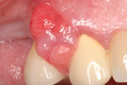 Figure 1: Periodontal abscess treated during the COVID-19 pandemic. The patient admitted to being stressed. Figure 1: Periodontal abscess treated during the COVID-19 pandemic. The patient admitted to being stressed.