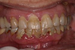 Figure 2: This patient neglected his teeth during the COVID-19 pandemic, stating &apos;his mind was worried about other things.&apos;