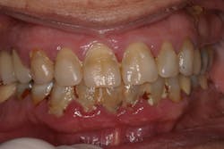 Figure 2: This patient neglected his teeth during the COVID-19 pandemic, stating 'his mind was worried about other things.' Figure 2: This patient neglected his teeth during the COVID-19 pandemic, stating 'his mind was worried about other things.'