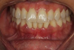 Figure 3: A once-controlled periodontal patient stopped good hygiene care and started smoking as well as increased alcohol use during the COVID-19 pandemic. This patient had quit smoking for five years prior. Figure 3: A once-controlled periodontal patient stopped good hygiene care and started smoking as well as increased alcohol use during the COVID-19 pandemic. This patient had quit smoking for five years prior.