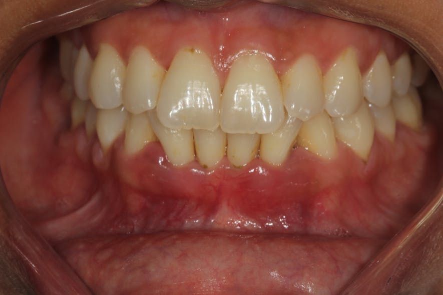 Figure 3: A once-controlled periodontal patient stopped good hygiene care and started smoking as well as increased alcohol use during the COVID-19 pandemic. This patient had quit smoking for five years prior.