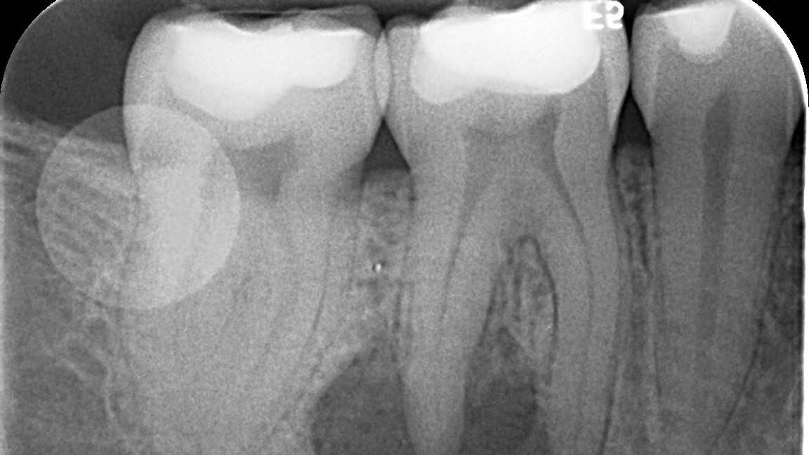 tooth periapical lesion