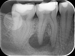 Figure 1: Pre-op tooth no. 30 Figure 1: Pre-op tooth no. 30