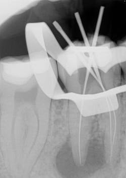 Figure 2: Working length Figure 2: Working length