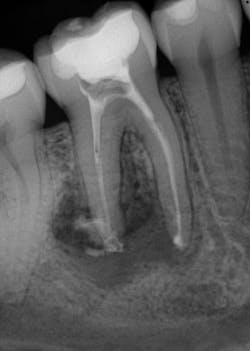 Figure 3: One month—Ca(OH)2 Figure 3: One month—Ca(OH)2