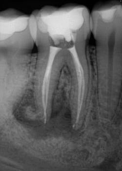 Figure 4: Four-month review and obturation Figure 4: Four-month review and obturation