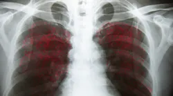 Chirawan Somsanuk Dreamstime Covid 19 Lungs