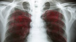 Chirawan Somsanuk Dreamstime Covid 19 Lungs 5f32feca3f820 Chirawan Somsanuk Dreamstime Covid 19 Lungs 5f32feca3f820