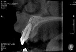 Figure 1: CBCT image of tooth no. 7 with advanced bone loss and no buccal or palatal plate