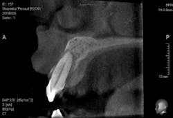 Figure 1: CBCT image of tooth no. 7 with advanced bone loss and no buccal or palatal plate Figure 1: CBCT image of tooth no. 7 with advanced bone loss and no buccal or palatal plate