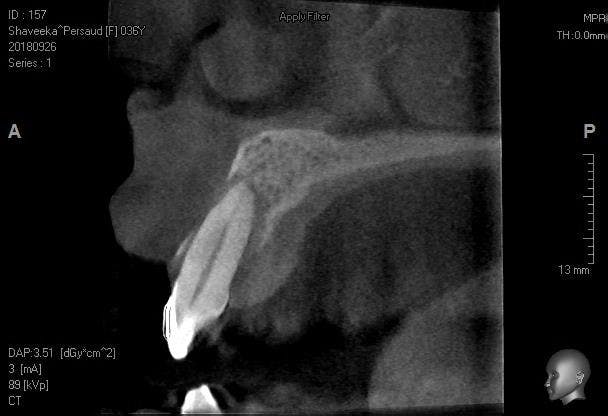 Figure 1: CBCT image of tooth no. 7 with advanced bone loss and no buccal or palatal plate