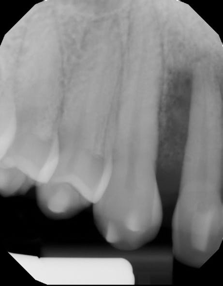 Figure 2: Radiograph of tooth nos. 6&ndash;8 showing all teeth with severe bone loss