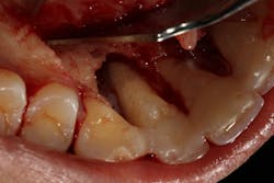 Figure 3: Clinical photo of tooth nos. 6–8 after surgical debridement and showing a large bony defect Figure 3: Clinical photo of tooth nos. 6–8 after surgical debridement and showing a large bony defect